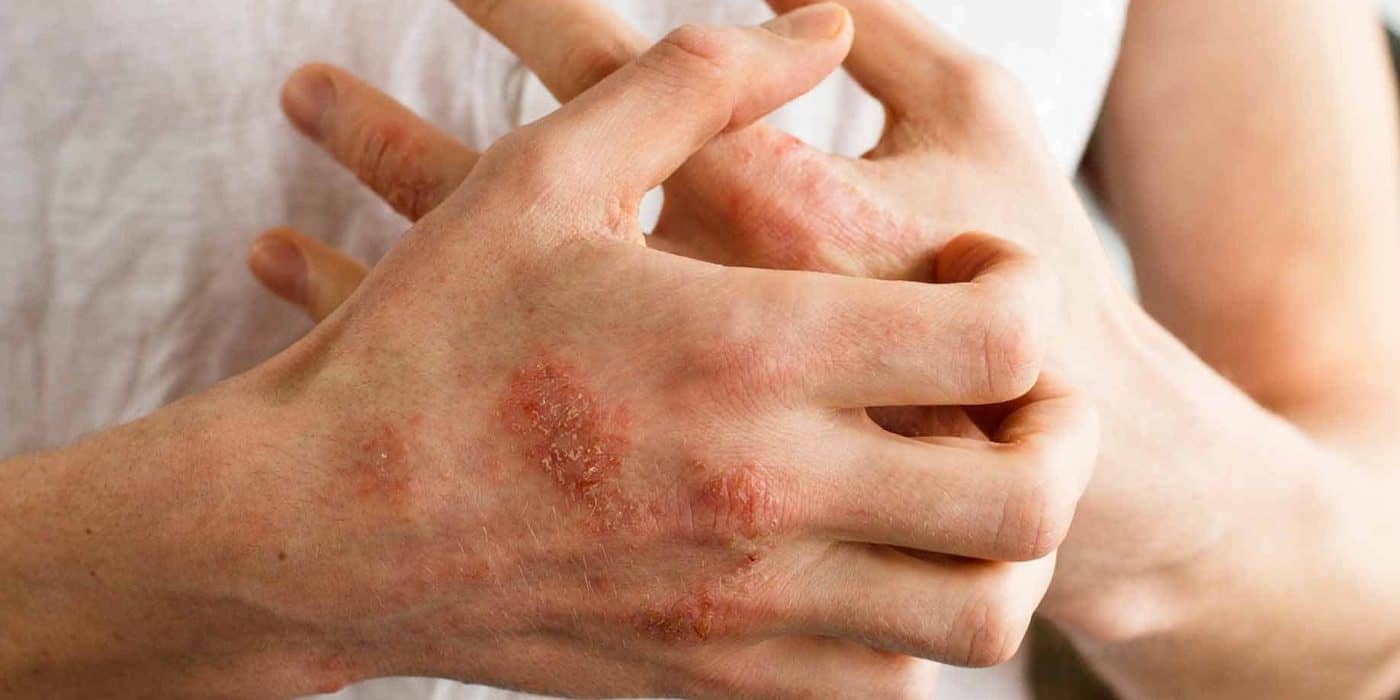 Blog esclerodermia