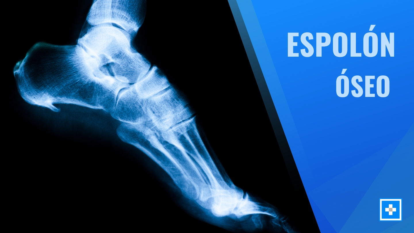 Espolones óseos
