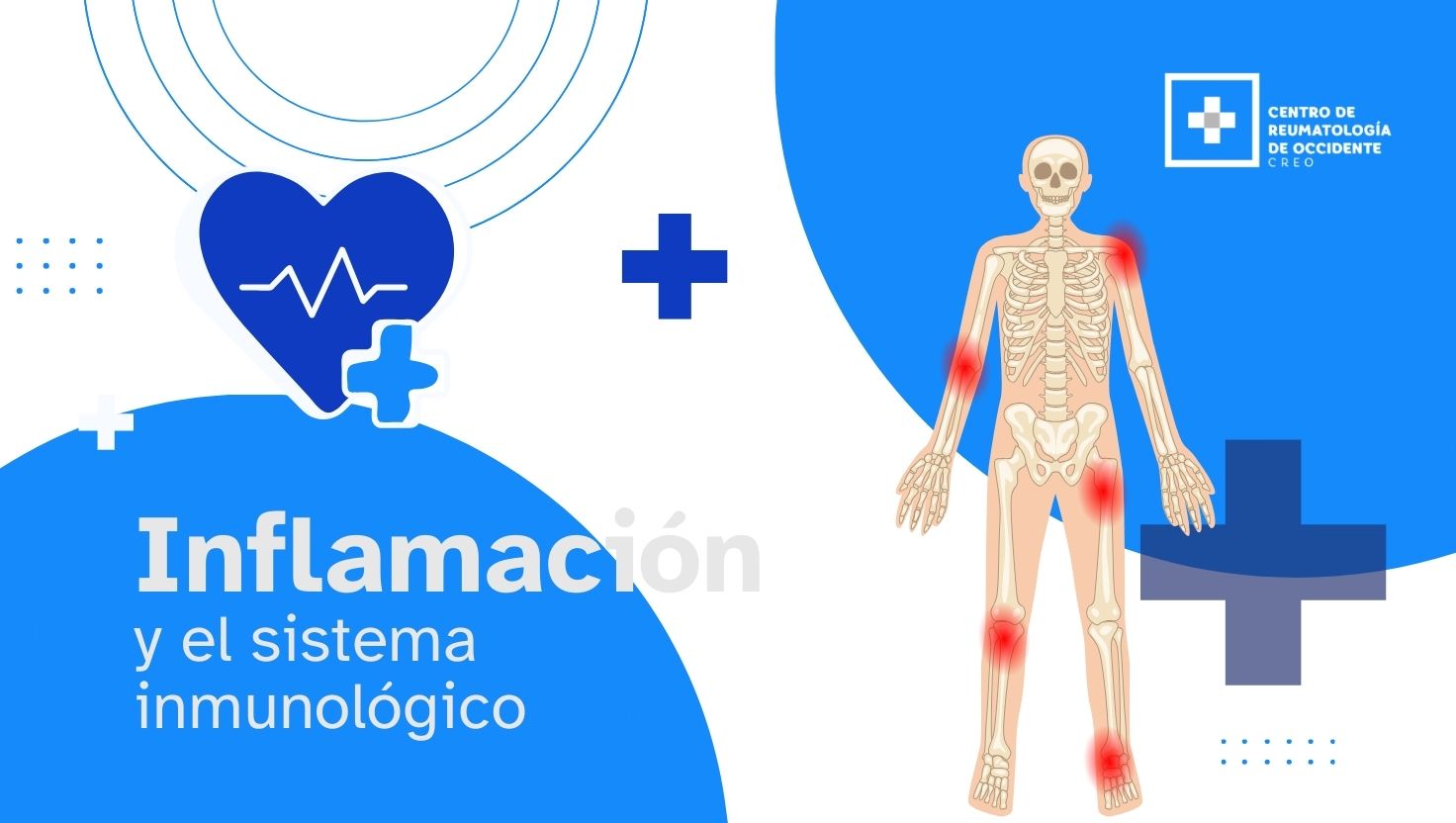Inflamación y sistema inmunológico: cómo se relacionan con las enfermedades reumáticas