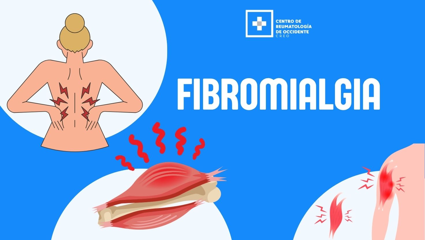 fibromialgia